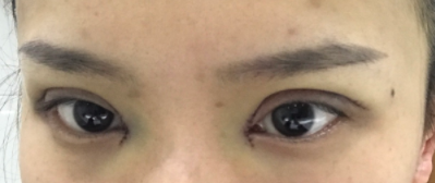 長(zhǎng)春麥西美嘉整形醫(yī)生王圣博做雙眼皮手術(shù)效果怎么樣？附雙眼皮案例