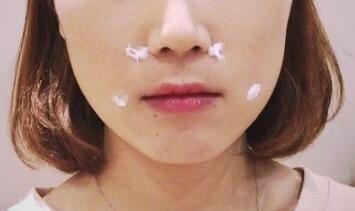 信陽東方藝美容醫(yī)院劉力萌做玻尿酸去法令紋效果怎么樣？附案例效果對比圖