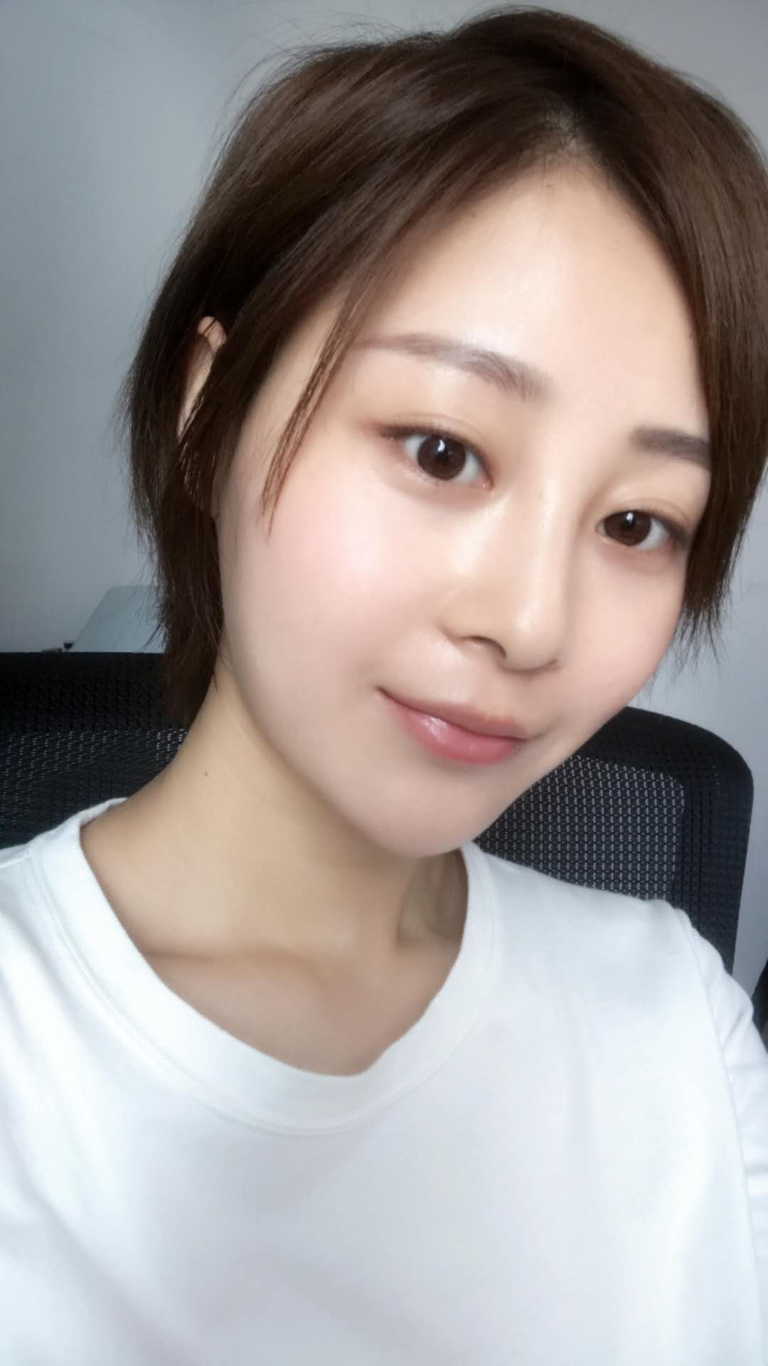 天津歐華威莎整形醫(yī)生姚玲做面部埋線提升效果怎么樣？附埋線提升案例
