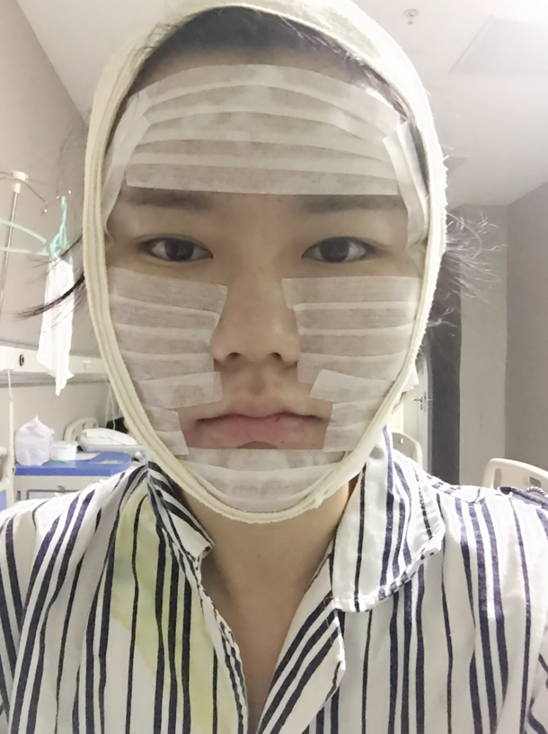 沈陽友誼整形美容醫(yī)院金顕哲醫(yī)生做自體脂肪填充臉部+V-LINE瓜子臉手術案例效果圖