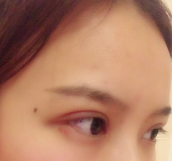 長(zhǎng)春麥西美嘉整形醫(yī)生王圣博做雙眼皮手術(shù)效果怎么樣？附雙眼皮案例