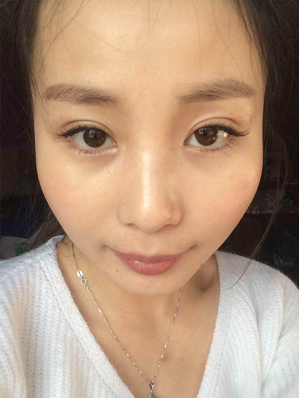 桂林新華醫(yī)療美容醫(yī)生李新華做雙眼皮手術(shù)怎么樣？李新華雙眼皮手術(shù)案例