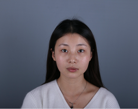 桂林新華醫(yī)療美容醫(yī)生李新華做雙眼皮手術(shù)怎么樣？李新華雙眼皮手術(shù)案例