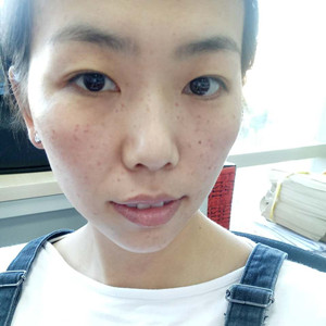 珠海蒂伊醫(yī)療整形醫(yī)生廖俊凱做激光祛斑效果怎么樣？附激光祛斑案例效果圖