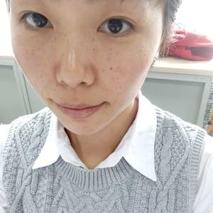 珠海蒂伊醫(yī)療整形醫(yī)生廖俊凱做激光祛斑效果怎么樣？附激光祛斑案例效果圖