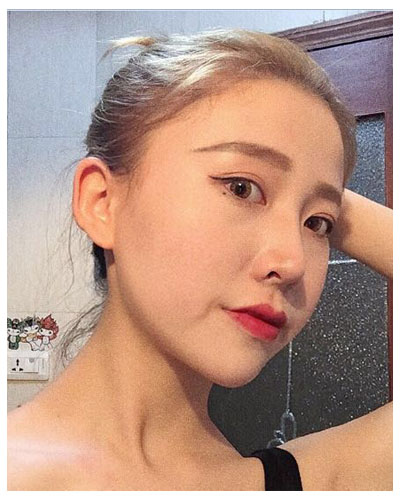 珠海海大整形美容外科黃發(fā)醫(yī)生做面部吸脂怎么樣？附面部吸脂案例