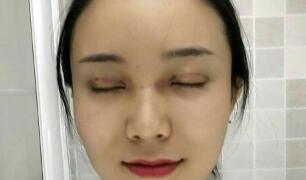 長沙微笑醫(yī)療整形醫(yī)生段雙軍做切開雙眼皮+開內(nèi)眼角效果怎么樣？附案例