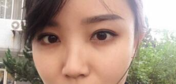 長沙微笑醫(yī)療整形醫(yī)生段雙軍做切開雙眼皮+開內(nèi)眼角效果怎么樣？附案例