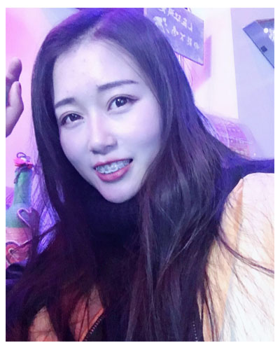 義烏傅氏口腔醫(yī)生朱雨晴做牙齒隱形矯正效果怎么樣？附牙齒隱形矯正案例