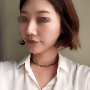 太原麗都整形醫(yī)院劉晉艷醫(yī)生做光纖溶脂瘦臉怎么樣？附案例效果對(duì)比圖