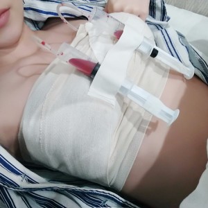 廣州廣大整形美容醫(yī)院醫(yī)生查旭山做假體隆胸怎么樣？附案例