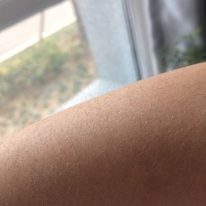 鄭州屈小麗醫(yī)療整形醫(yī)院醫(yī)生劉丹做手臂脫毛怎么樣？附手臂脫毛案例
