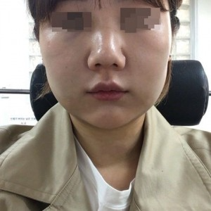 太原麗都整形醫(yī)院劉晉艷醫(yī)生做光纖溶脂瘦臉怎么樣？附案例效果對(duì)比圖