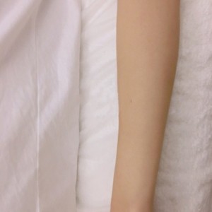 鄭州屈小麗醫(yī)療整形醫(yī)院醫(yī)生劉丹做手臂脫毛怎么樣？附手臂脫毛案例