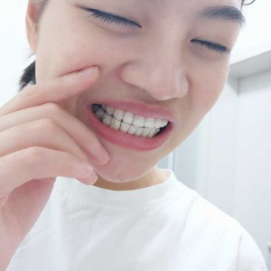 廈門拜博口腔醫(yī)院醫(yī)生張忠做牙齒隱形矯正怎么樣？附案例效果對比圖