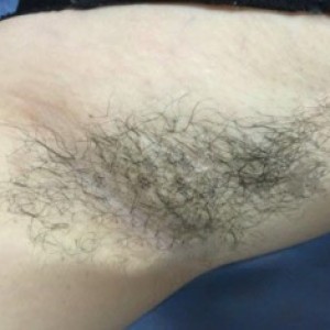 廈門張銘整醫(yī)療整形醫(yī)生張小玲做激光脫腋毛怎么樣？附激光脫腋毛效果對比圖
