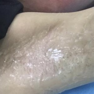 廈門張銘整醫(yī)療整形醫(yī)生張小玲做激光脫腋毛怎么樣？附激光脫腋毛效果對比圖