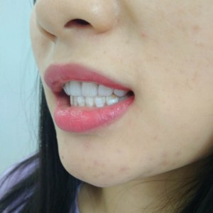 洛陽友好口腔醫(yī)院醫(yī)生李新然做牙貼面怎么樣？附案例效果圖
