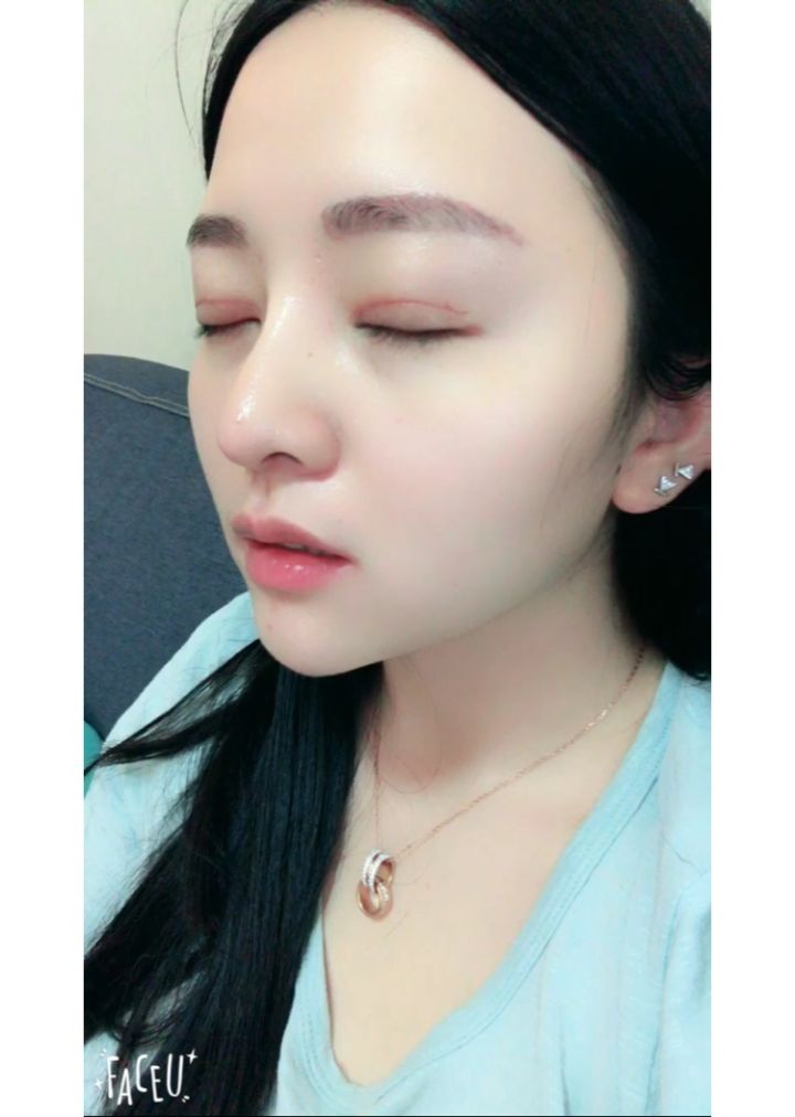 北京京韓整形醫(yī)生王義山做埋線雙眼皮怎么樣？附案例效果對比圖