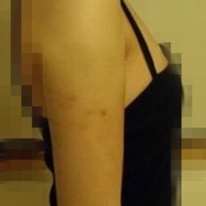 岳陽愛思特醫(yī)療美容醫(yī)院醫(yī)生王福生做手臂吸脂怎么樣？附案例效果圖