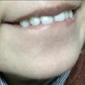 洛陽(yáng)友好口腔醫(yī)院醫(yī)生楊?lèi)?ài)芳做牙齒冷光美白怎么樣？附案例效果圖