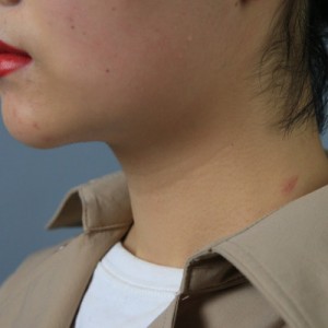 上海名媛醫(yī)療整形醫(yī)生閆嬌君做嗨體去頸紋效果怎么樣？附案例效果圖