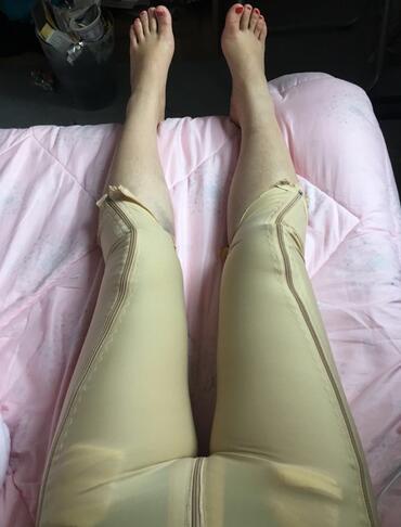 上海保加醫(yī)療美容門診部做大腿吸脂怎么樣？附楊勇醫(yī)生案例效果對比圖