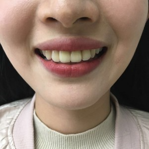 上?？仆呖谇会t(yī)院醫(yī)生鄧建儒做牙齒冷光美白怎么樣？附案例效果對比圖