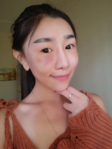 貴陽(yáng)泰康樂(lè)醫(yī)院整形美容科醫(yī)生陳璐做自體脂肪全臉填充效果怎么樣？