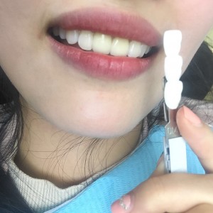 上?？仆呖谇会t(yī)院醫(yī)生鄧建儒做牙齒冷光美白怎么樣？附案例效果對比圖
