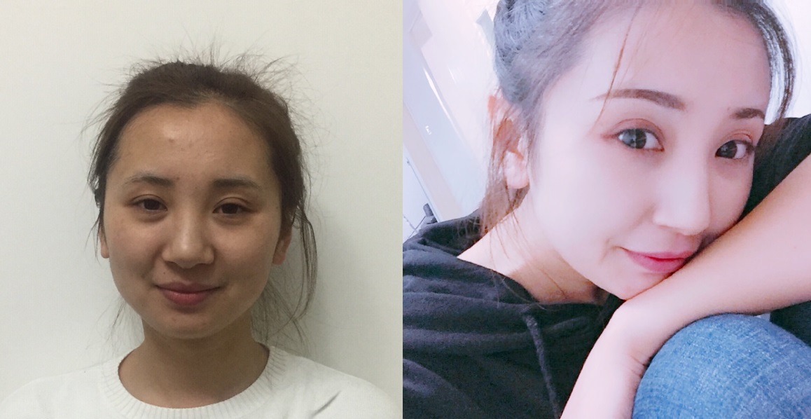 貴陽藝齡醫(yī)療美容門診部醫(yī)生李章做隆鼻手術(shù)怎么樣？附案例效果對比圖