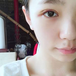 鄭州安格潤(rùn)整形醫(yī)生楊曉紅做雙眼皮手術(shù)怎么樣？附案例效果圖