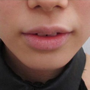 蚌埠韓美美萊整形醫(yī)院醫(yī)生張濤做玻尿酸墊下巴怎么樣？來看案例效果圖