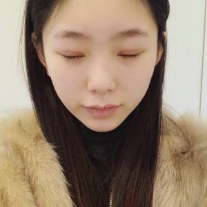 鄭州安格潤(rùn)整形醫(yī)生楊曉紅做雙眼皮手術(shù)怎么樣？附案例效果圖
