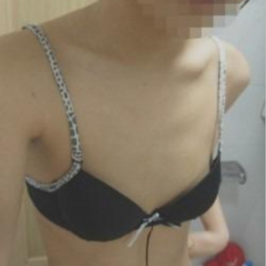 三亞圣迪亞整形美容醫(yī)院醫(yī)生韓超做假體隆胸怎么樣？附案例效果對比圖