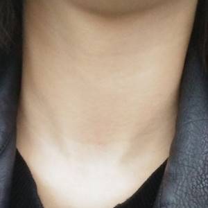 昭通愛麗諾整形醫(yī)生陳志江做嗨體去頸紋怎么樣？附案例效果圖