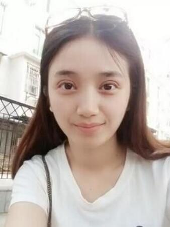 長治松禾醫(yī)療美容診所醫(yī)生馬俊峰做韓式微創(chuàng)定點雙眼皮效果怎么樣？附案例