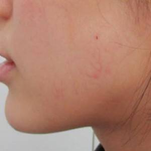 蚌埠韓美美萊整形醫(yī)院醫(yī)生張濤做玻尿酸墊下巴怎么樣？來看案例效果圖