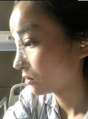 武漢米蘭醫(yī)療美容醫(yī)生柳再億做眼綜合+鼻綜合整形怎么樣？附真實(shí)案例對(duì)比圖