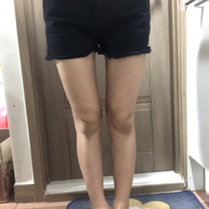 貴陽(yáng)華美整形美容醫(yī)院醫(yī)生田永華做大腿吸脂效果怎么樣？附大腿吸脂案例前后對(duì)比圖