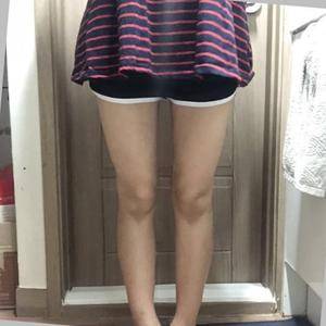貴陽(yáng)華美整形美容醫(yī)院醫(yī)生田永華做大腿吸脂效果怎么樣？附大腿吸脂案例前后對(duì)比圖