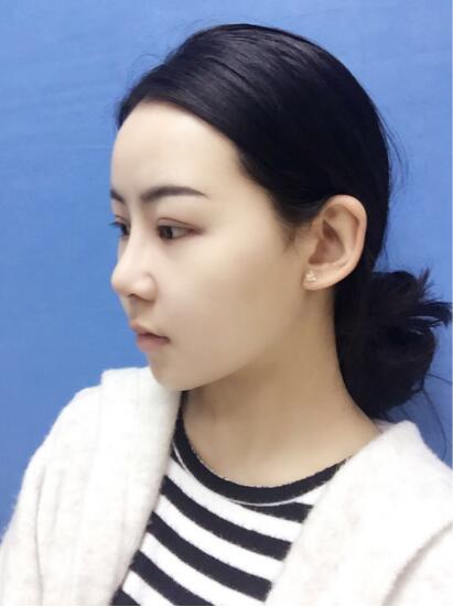 上海時(shí)光整形外科醫(yī)院醫(yī)生李靜林做假體隆鼻和反頜手術(shù)怎么樣？