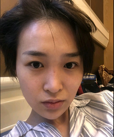 武漢米蘭醫(yī)療美容醫(yī)生柳再億做眼綜合+鼻綜合整形怎么樣？附真實(shí)案例對(duì)比圖