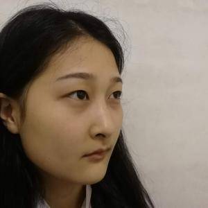 周口垣夢醫(yī)療整形醫(yī)生王濤做切開雙眼皮怎么樣？附切開雙眼皮案例效果對比圖
