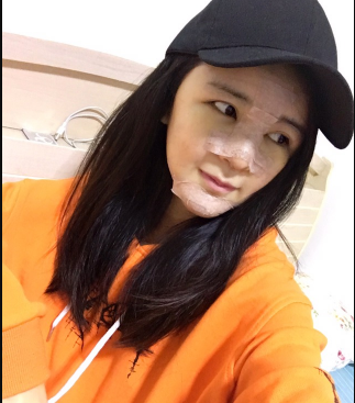 上海時光整形外科醫(yī)院醫(yī)生何晉龍做假體隆胸怎么樣？附案例效果對比圖