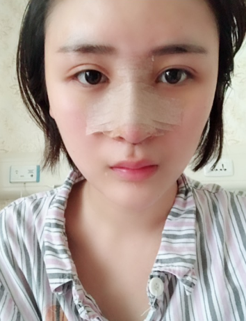 北京伊美爾美容愛(ài)康醫(yī)院醫(yī)生柳成做鼻綜合整形怎么樣？附案例效果圖
