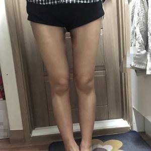 貴陽(yáng)華美整形美容醫(yī)院醫(yī)生田永華做大腿吸脂效果怎么樣？附大腿吸脂案例前后對(duì)比圖
