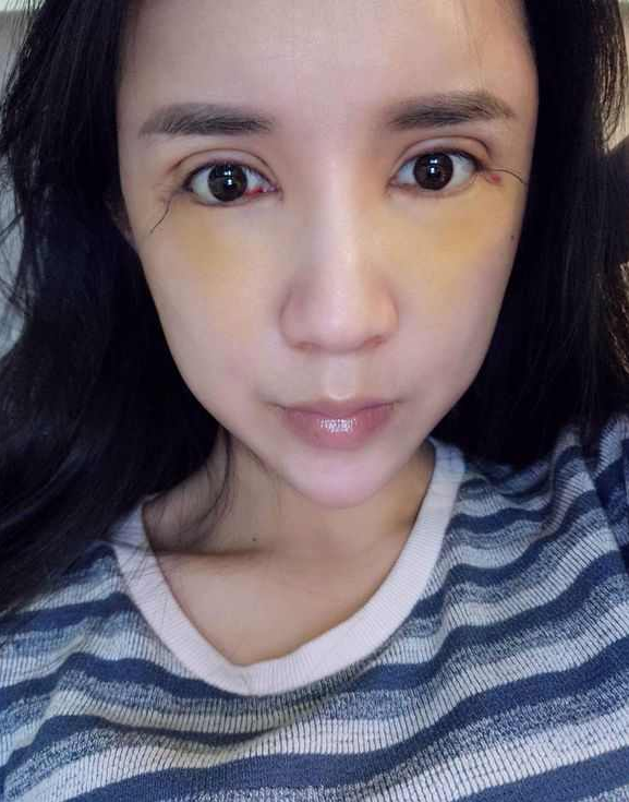 上海時(shí)光整形醫(yī)院張晶醫(yī)生做開眼角怎么樣？附真實(shí)效果圖