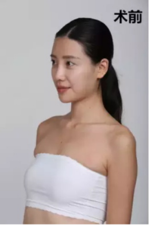 上海時光整形醫(yī)院何晉龍醫(yī)生做假體隆胸怎么樣？附案例對比圖