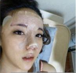 上海時(shí)光整形醫(yī)生何晉龍做假體隆鼻效果怎么樣？附案例效果對比圖
